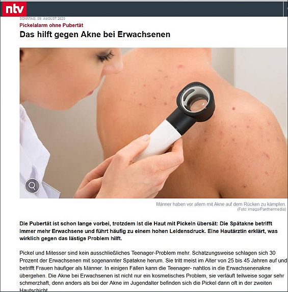 Pickelalarm ohne Pubertät: Das hilft gegen Akne bei Erwachsenen