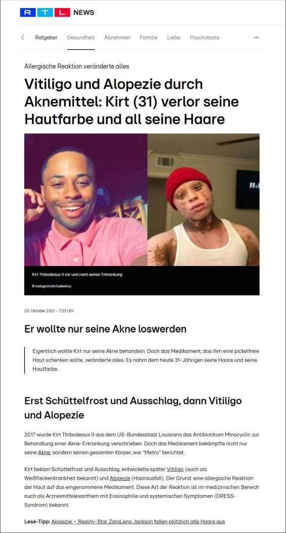 Vitiligo und Alopezie durch Aknemittel: Kirt (31) verlor seine Hautfarbe und all seine Haare