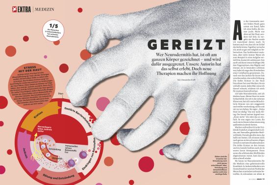 Gereizt: Wer Neurodermitis hat, ist oft am ganzen Körper gezeichnet. Doch neue Therapien machen Hoffnung